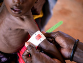 Somalia, Unicef: un bambino al minuto viene ricoverato per malnutrizione acuta grave